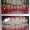 ...they also help remove internal stains and discolored teeth